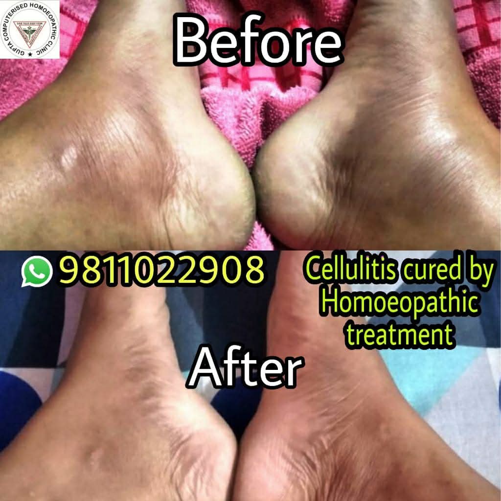 Cellulitis Treatment