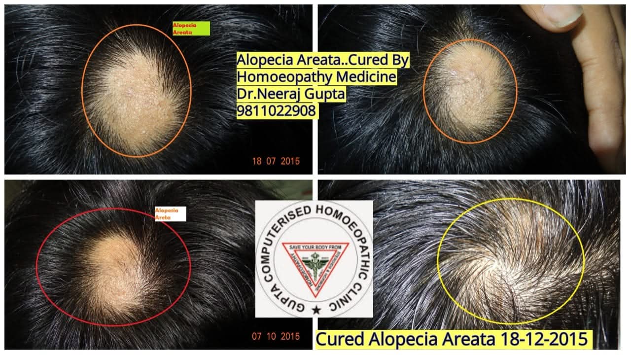 Fungal Infection Treatment