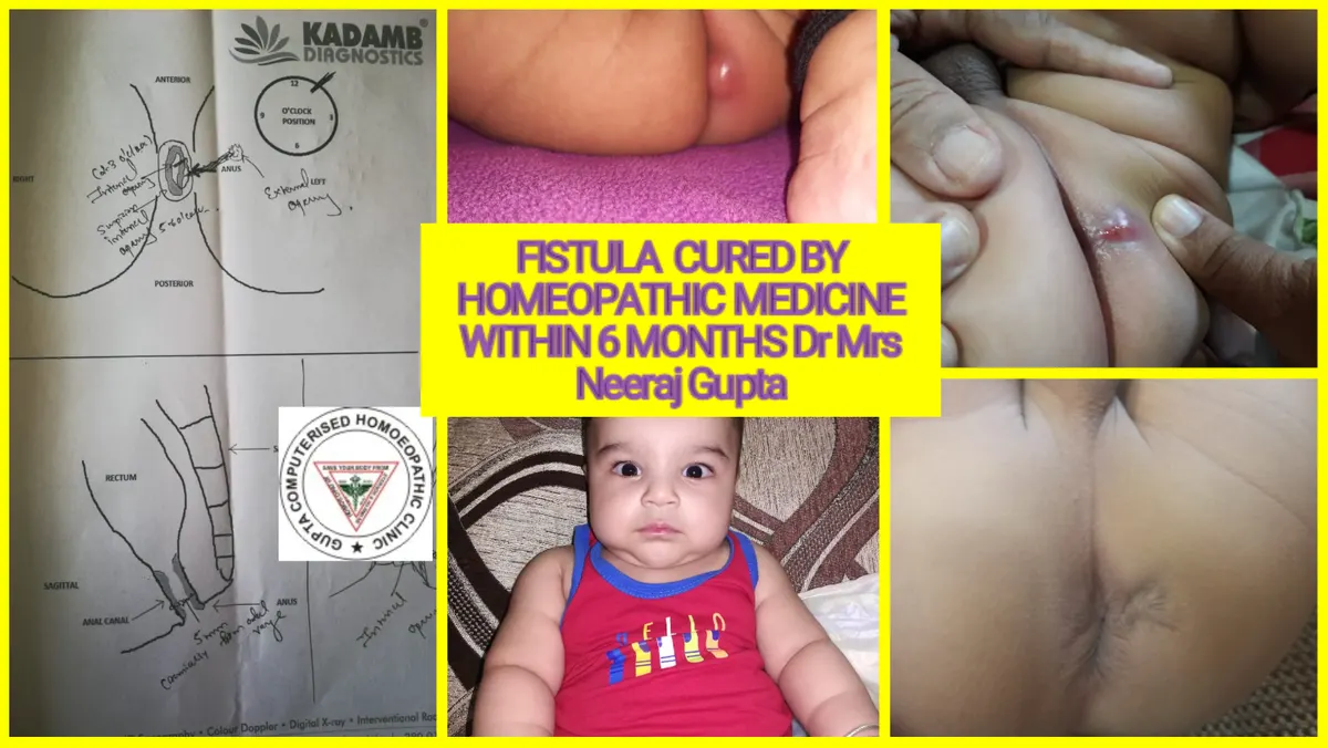 Chronic Urticaria Treatment