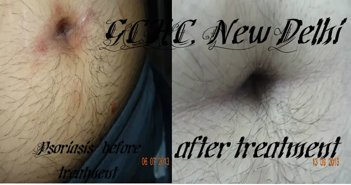 Melasma Treatment Results