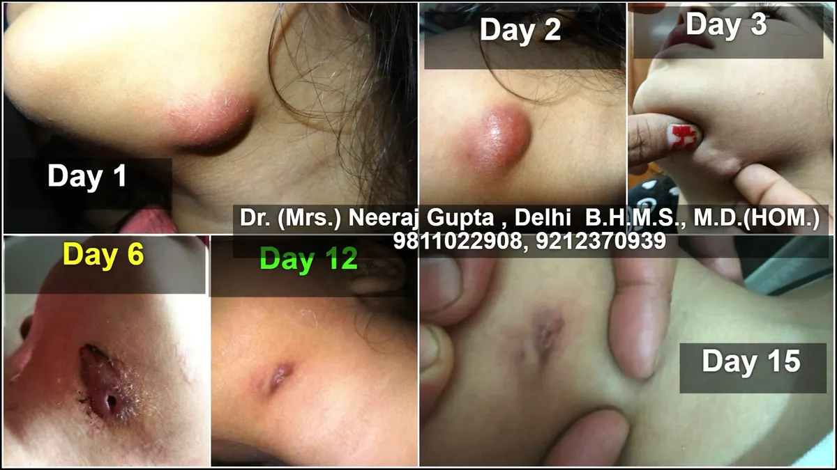 Keloid Scar Treatment
