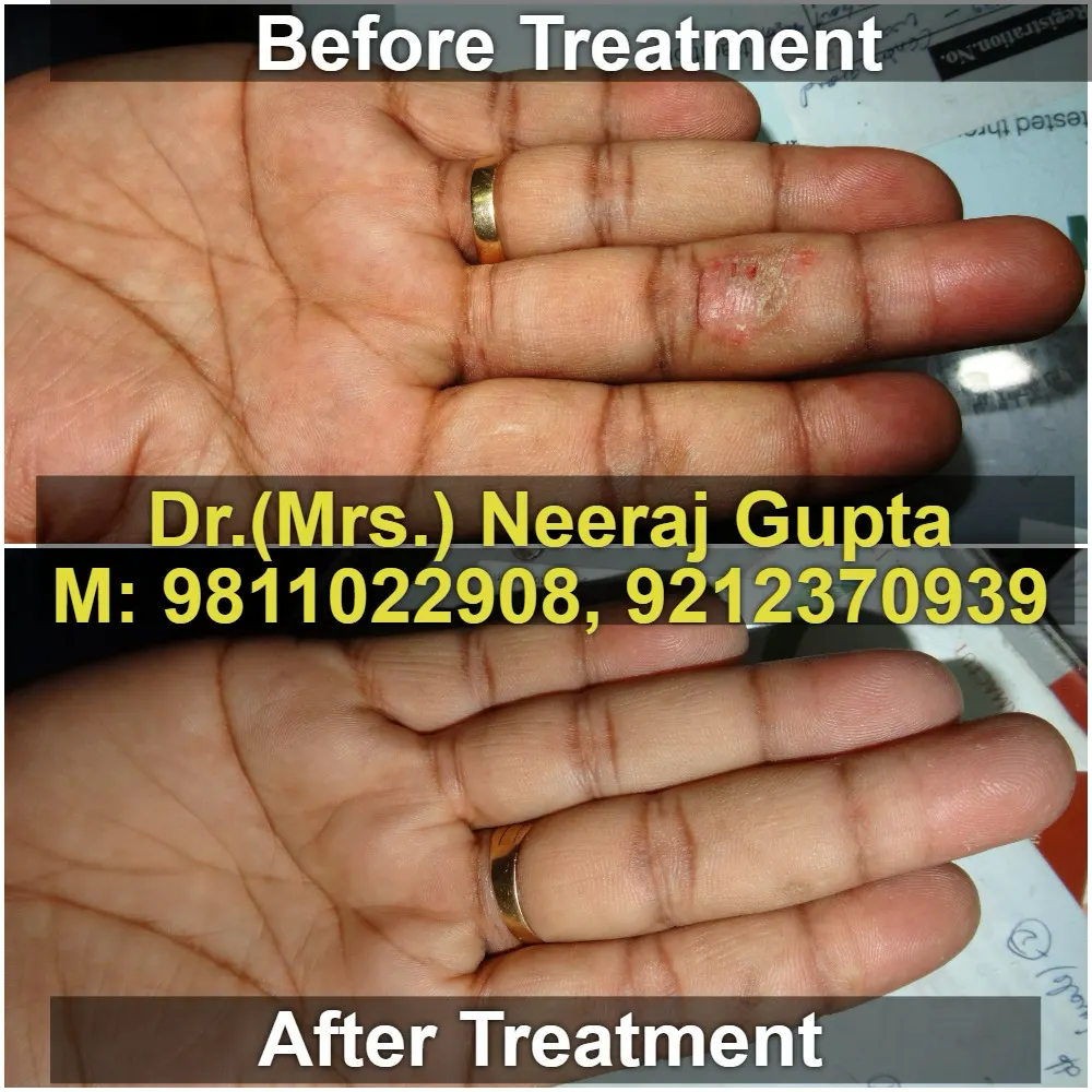 Acne Treatment Results