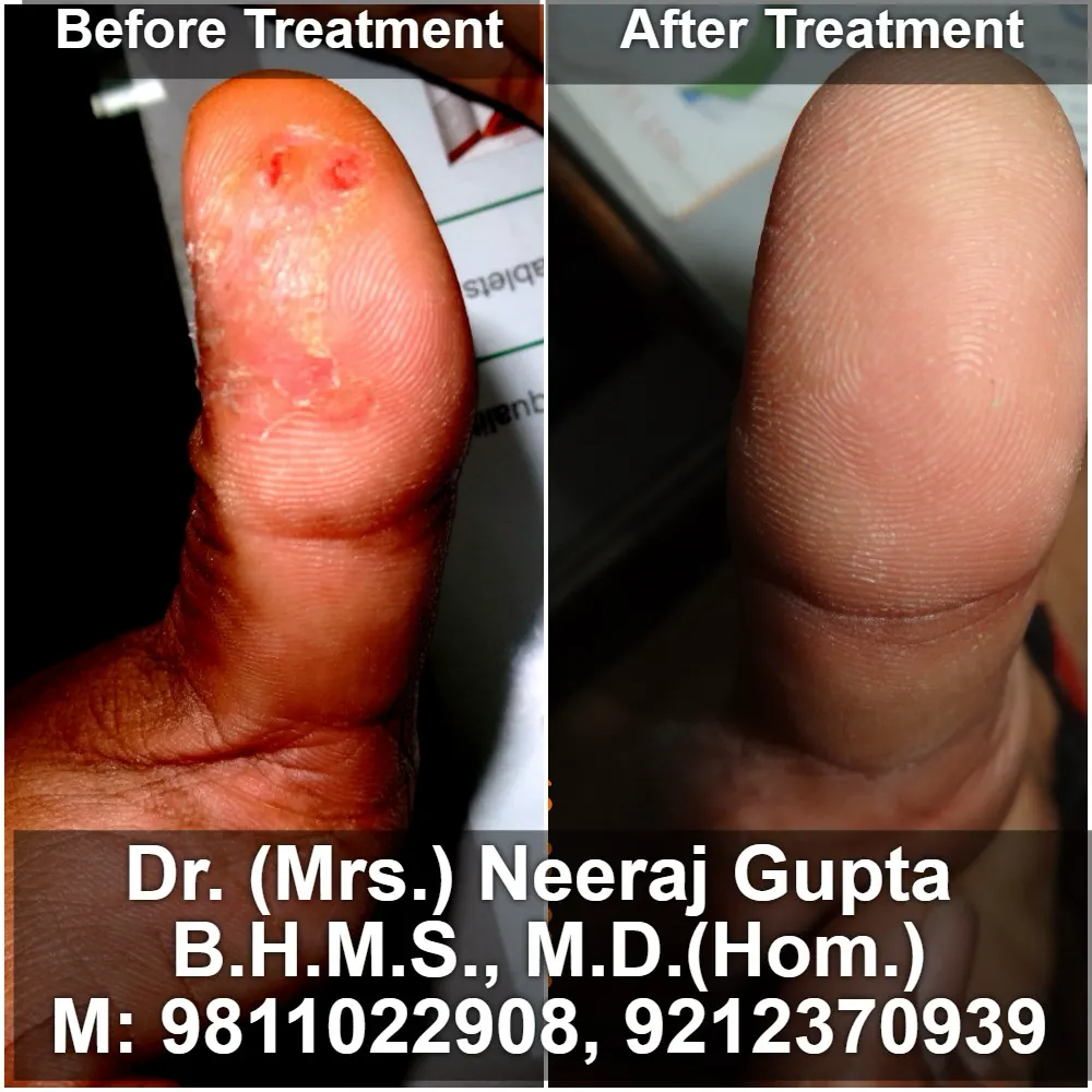 Alopecia Areata Recovery