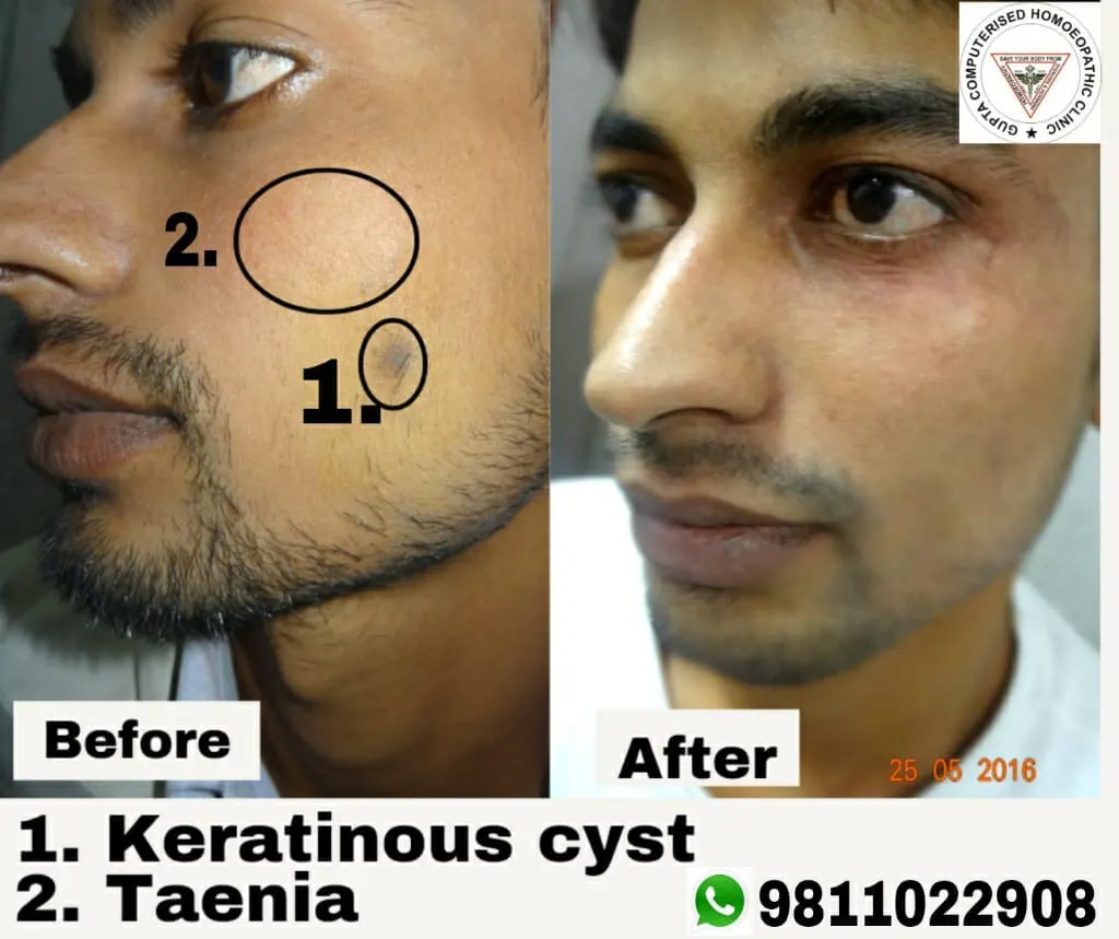 Vitiligo Treatment Progress